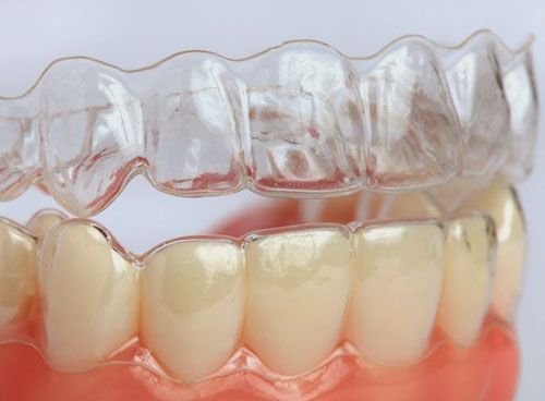 hàm chống nghiến nối liền 2 hàm